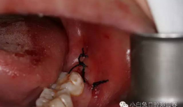 拔牙视频全过程